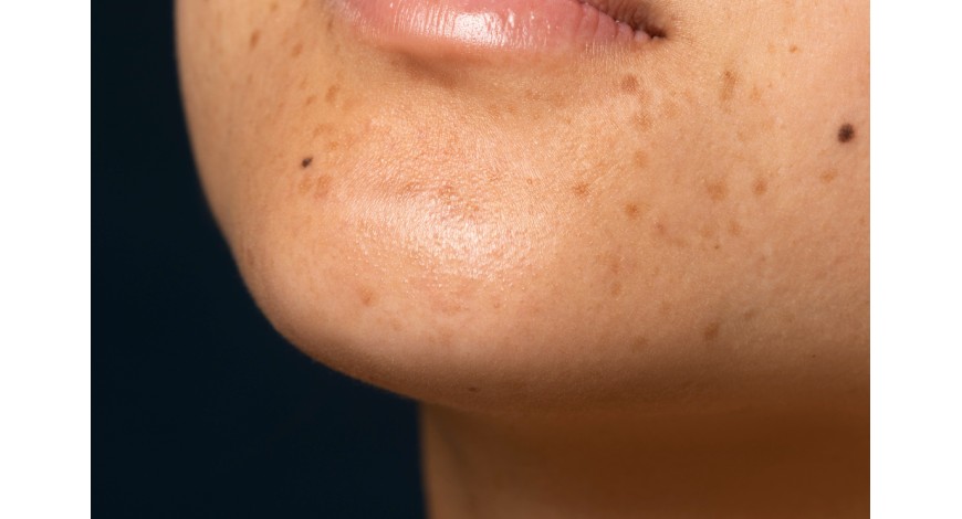 Protocole Clinique de Nuit : Comment Traiter Définitivement l'Hyperpigmentation et les Taches Brunes